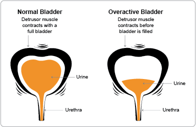 How do you treat bladder pain?