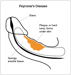 Peyronie's Disease Treatment Peyronie's Disease