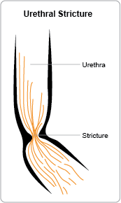 Urethral Stricture Urethral Stricture