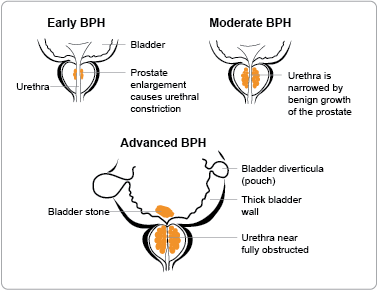 benign prostatic hyperplasia (bph) diagnosis