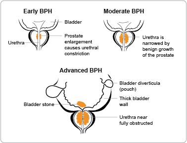 side effects of benign prostatic hypertrophy)