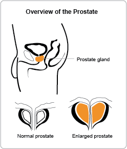 Prostate overview